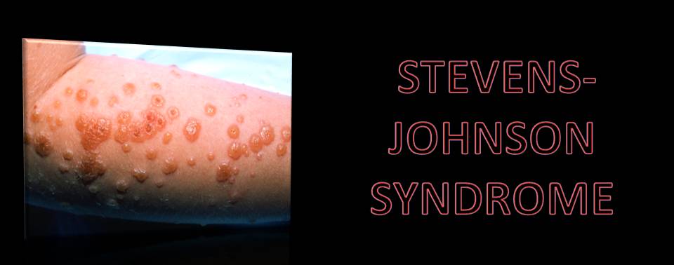 HOMOEOPATHIC APPROACH IN STEVENS- JOHNSON SYNDROME SJS