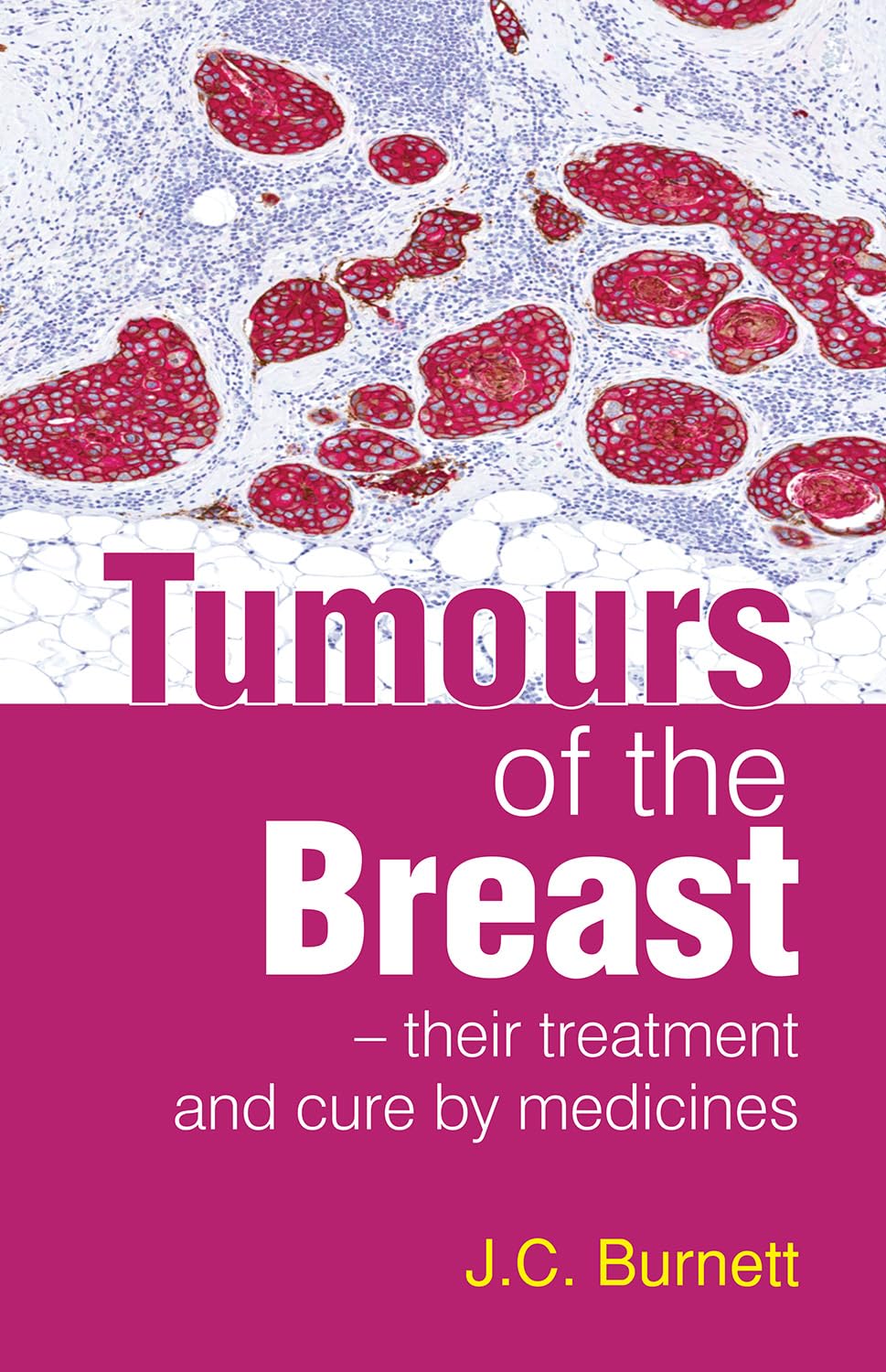 Tumours Of The Breast And Their Treatment And Cure By Medicine